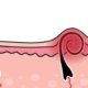 Foliculitis y Depilación